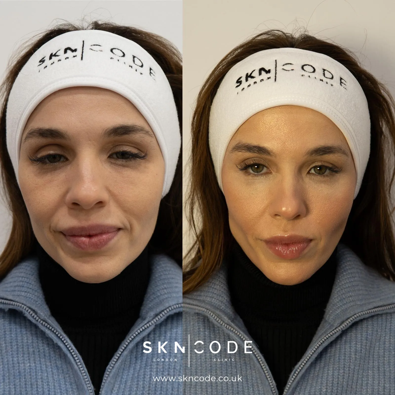 Before and after Anti-wrinkle injections at SKNCode London Clinic, photo 1