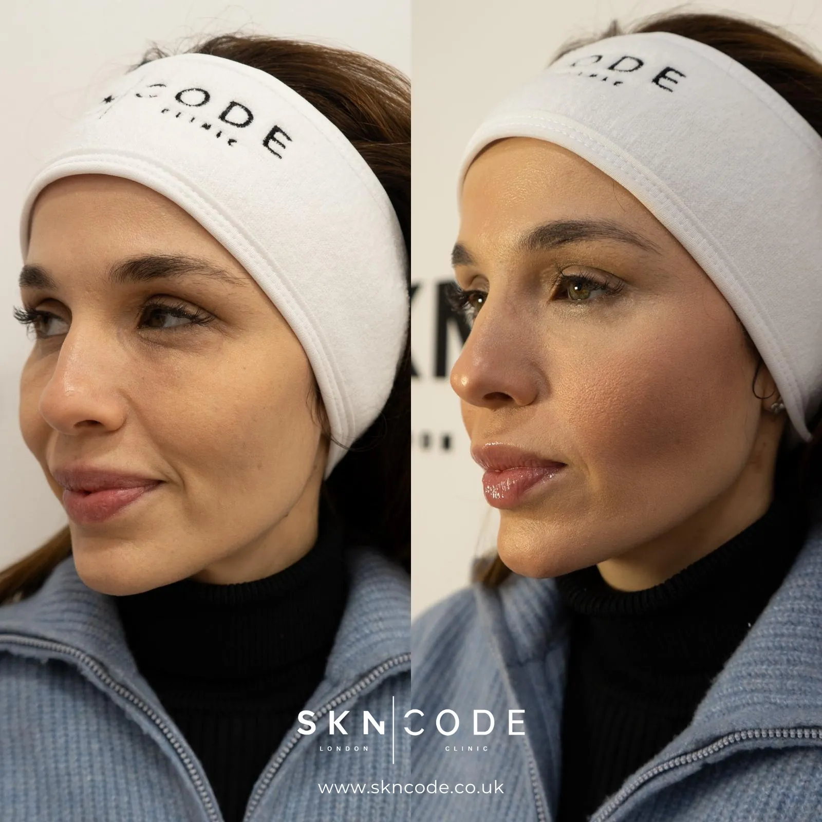 Before and after Anti-wrinkle injections at SKNCode London Clinic, photo 2