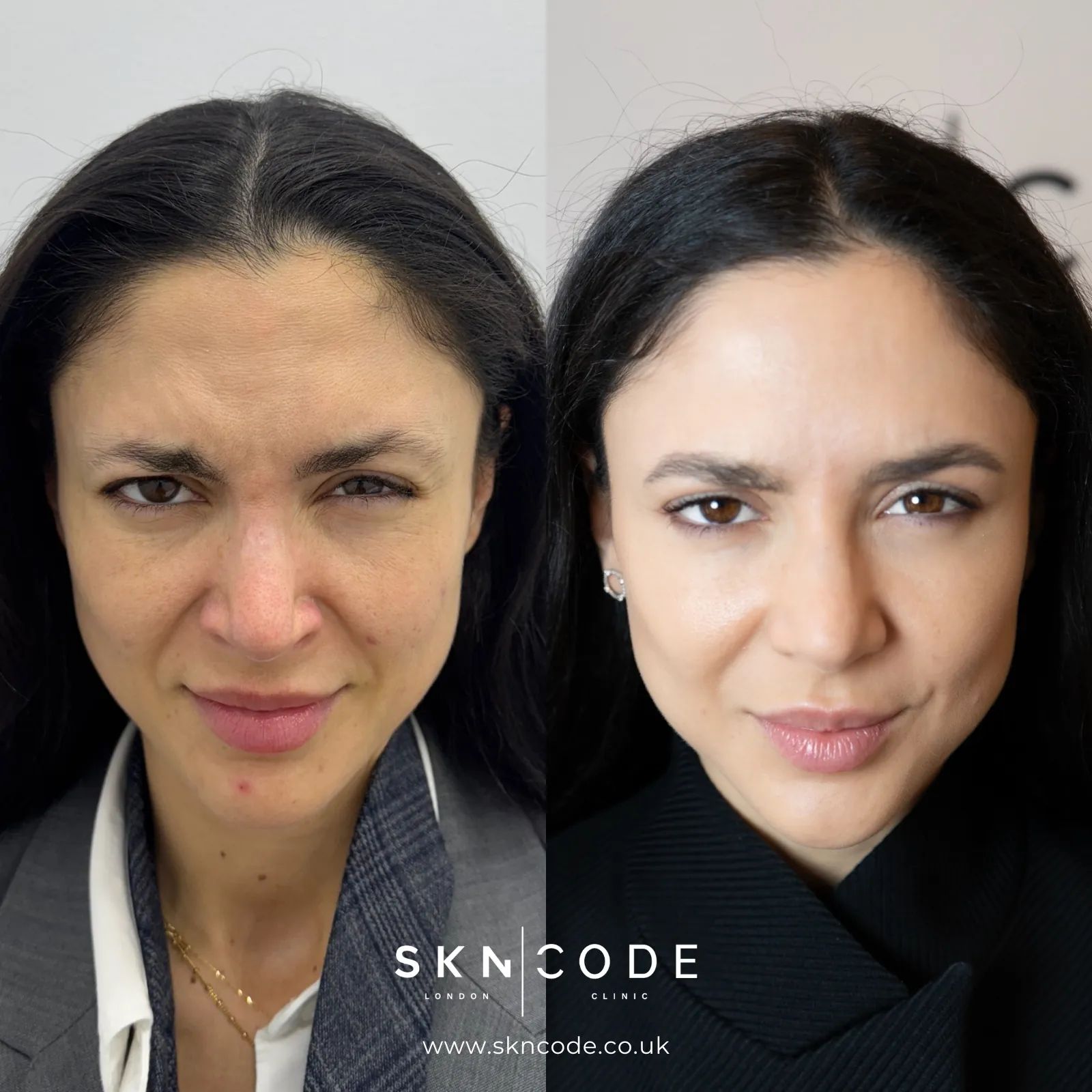 Before and after Anti-wrinkle injections at SKNCode London Clinic, photo 3