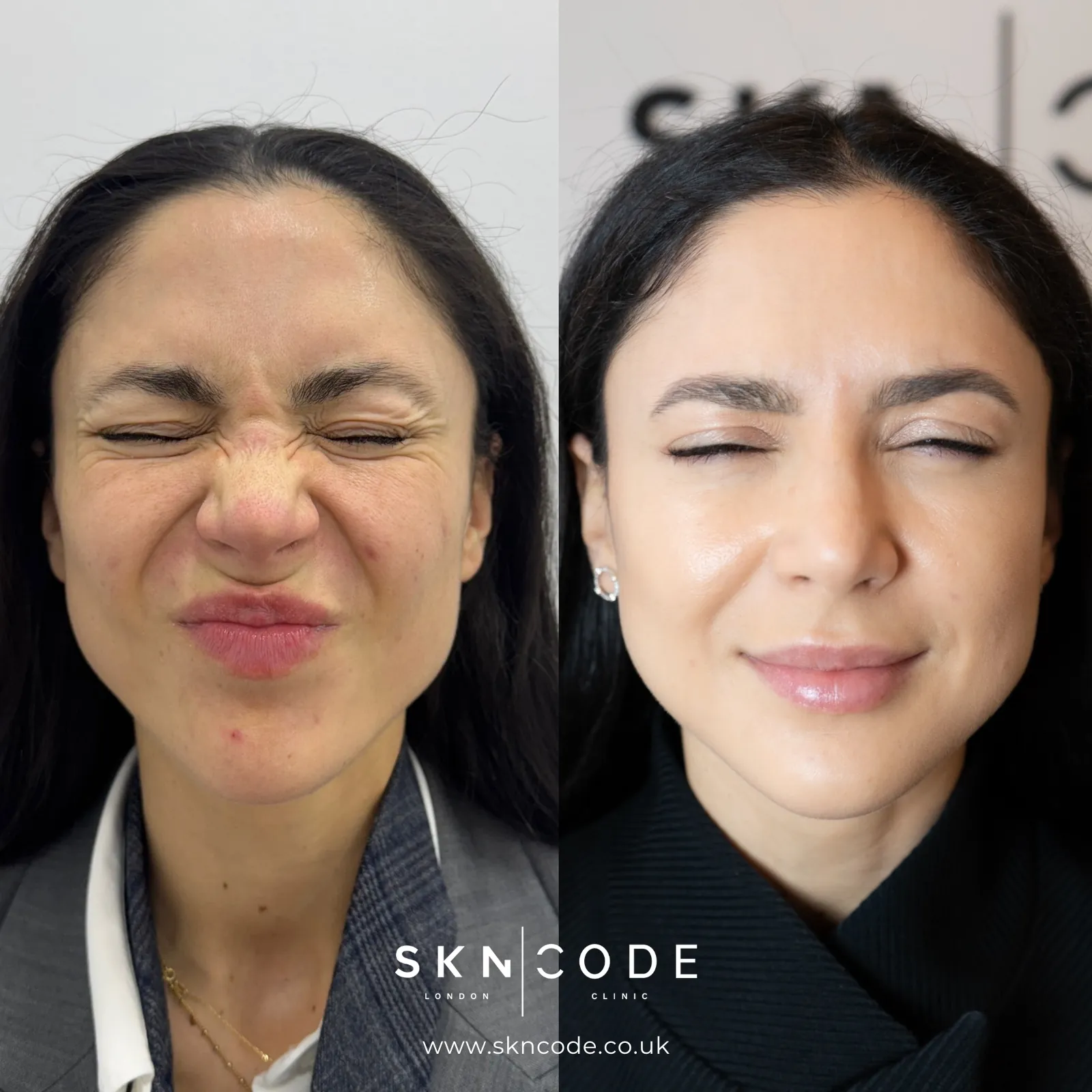 Before and after Anti-wrinkle injections at SKNCode London Clinic, photo 4
