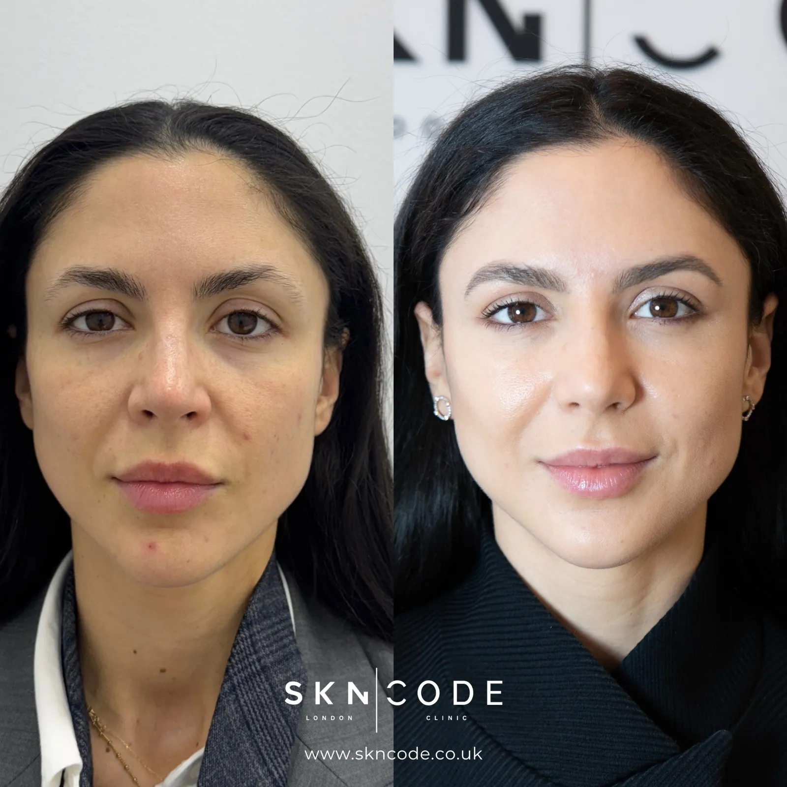 Before and after Anti-wrinkle injections at SKNCode London Clinic, photo 5