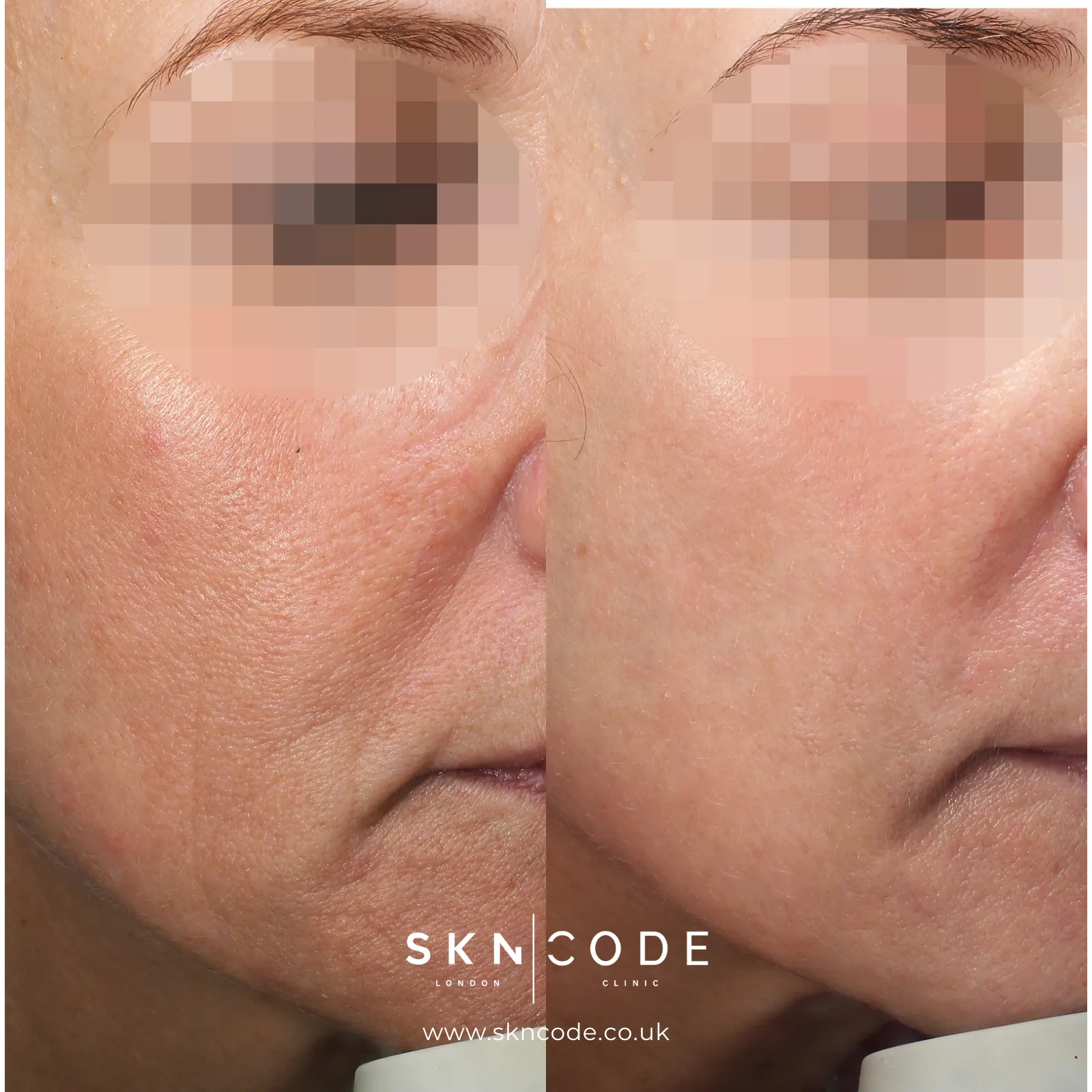Before and after Alma Hybrid CO2 laser at SKNCode London Clinic, photo 1