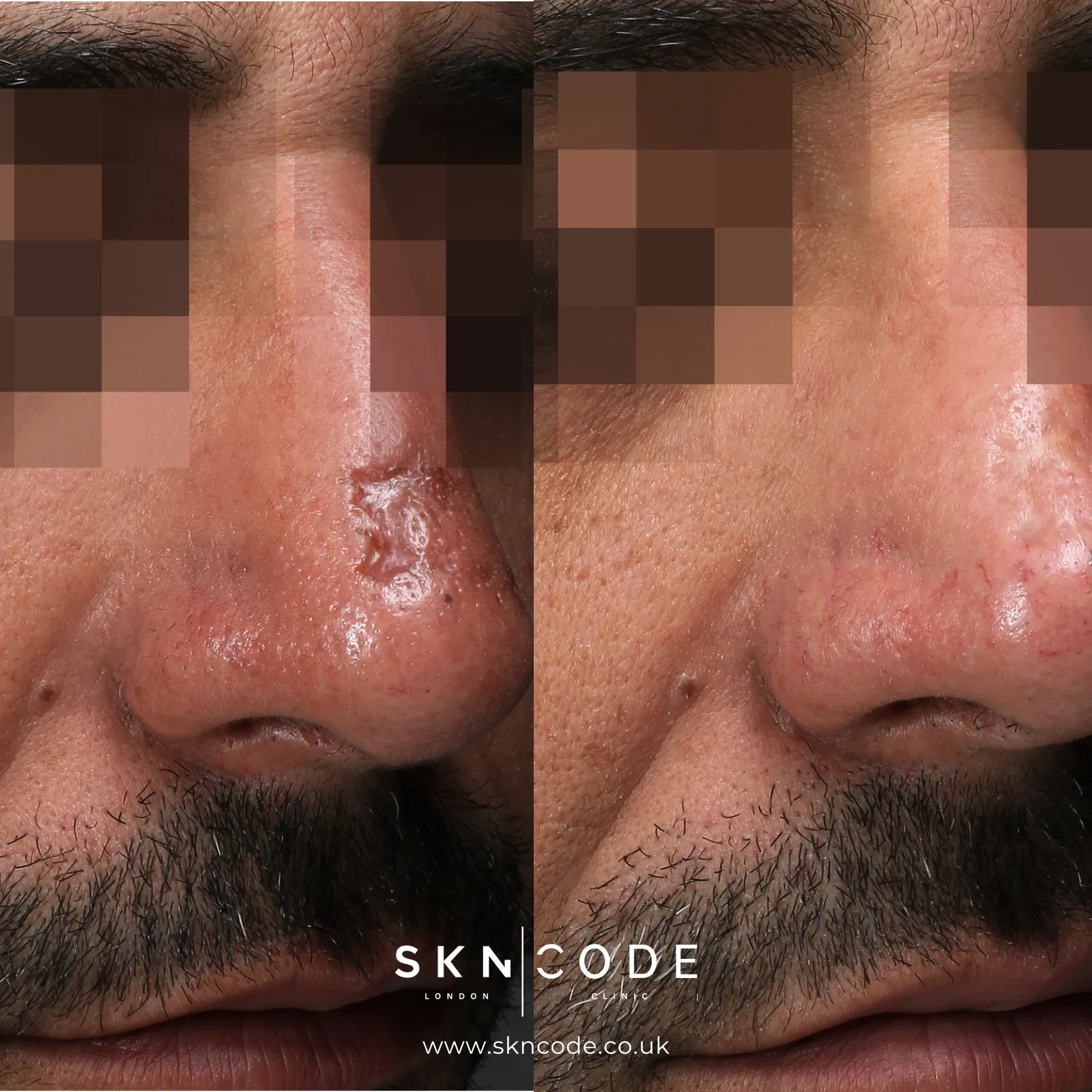 Before and after Alma Hybrid CO2 laser at SKNCode London Clinic, photo 2
