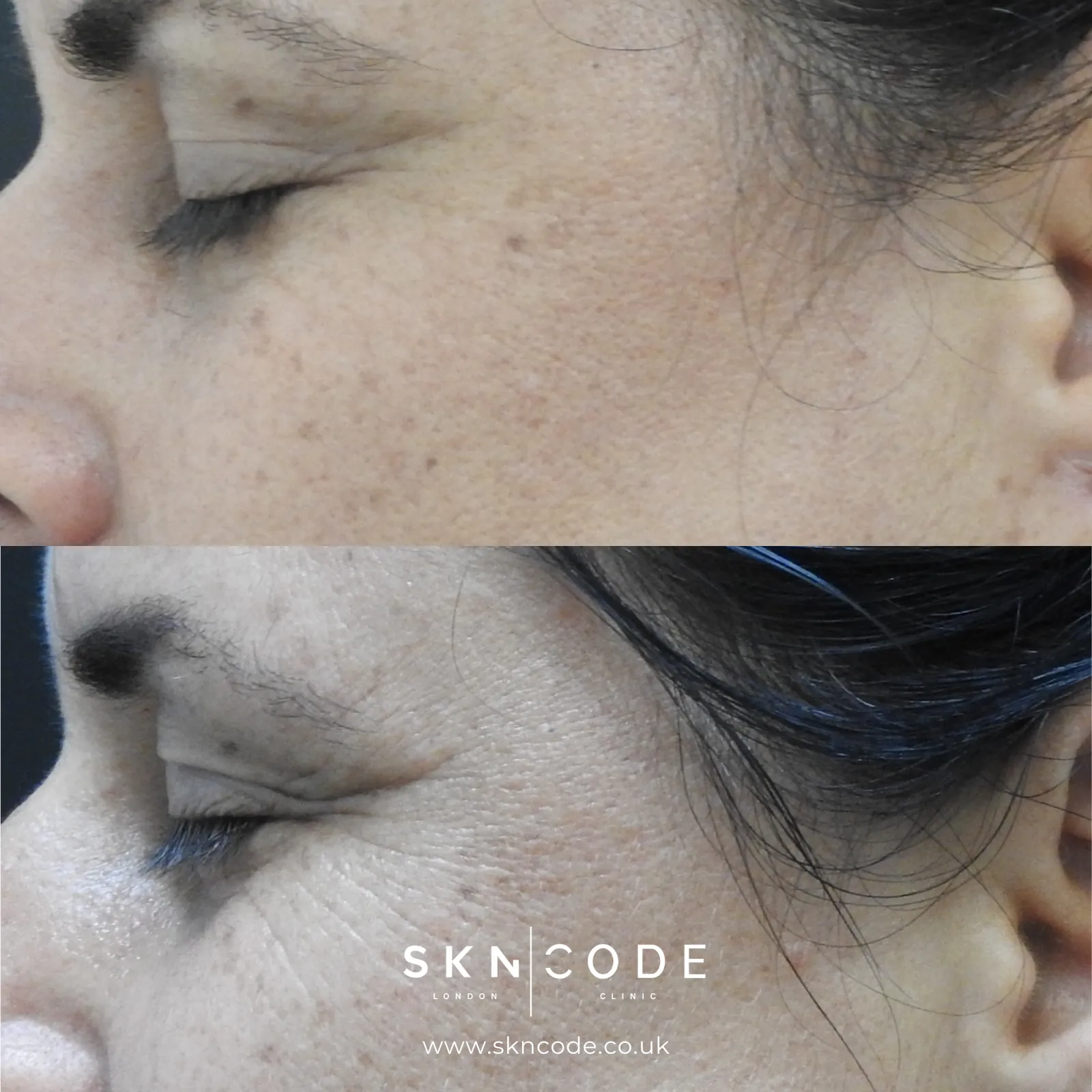Before and after Alma Hybrid CO2 laser at SKNCode London Clinic, photo 3