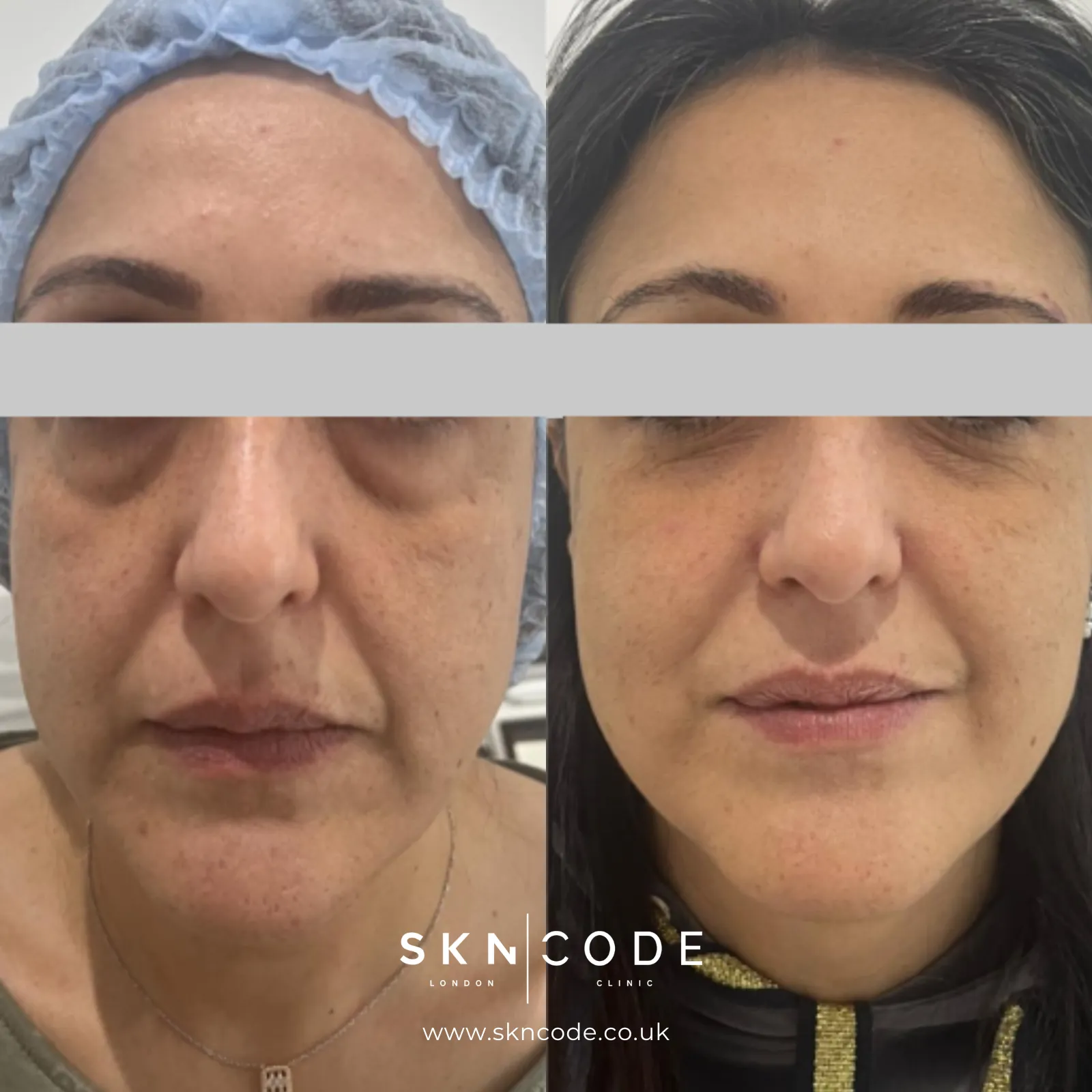 Before and after MCT at SKNCode London Clinic, photo 1