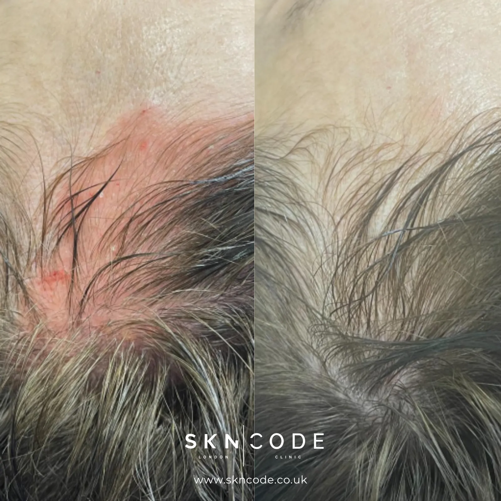 Before and after MCT at SKNCode London Clinic, photo 2