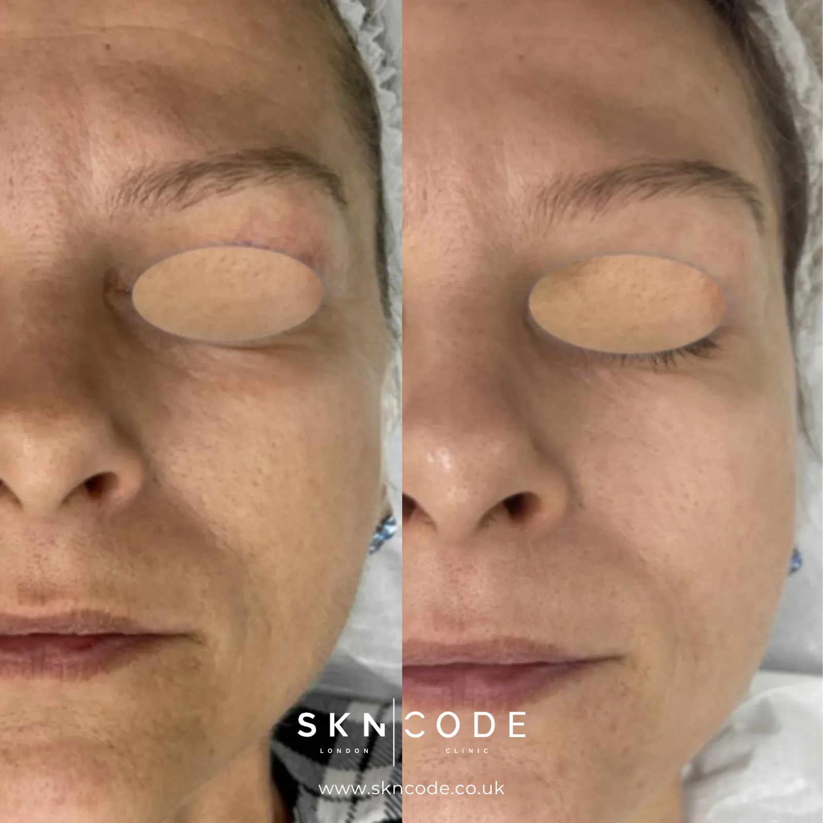 Before and after MCT at SKNCode London Clinic, photo 3