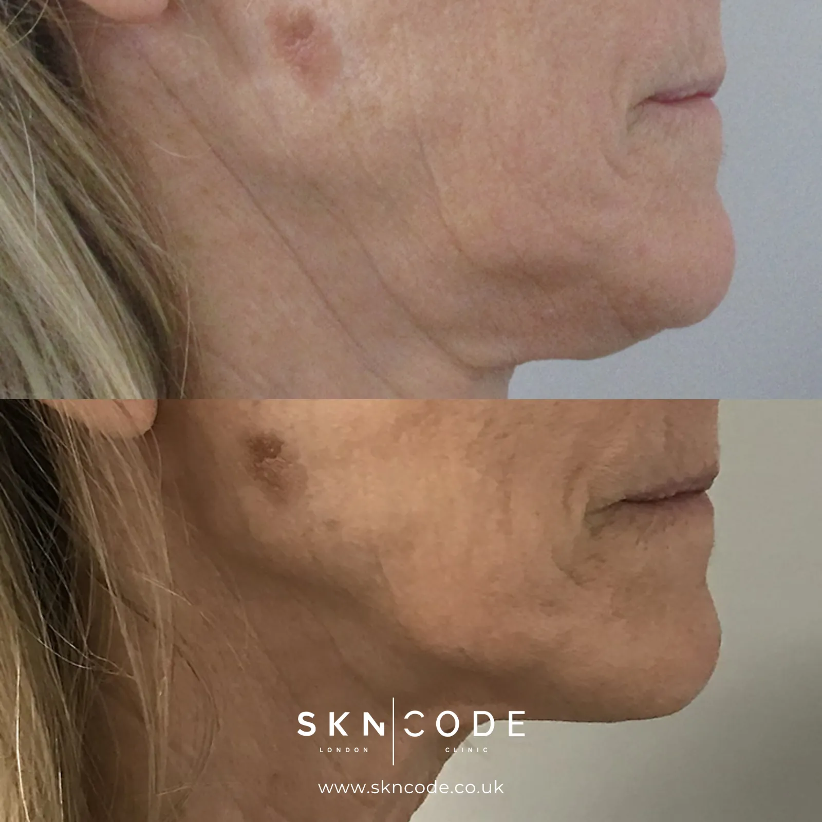 Before and after Morpheus8 at SKNCode London Clinic, photo 1