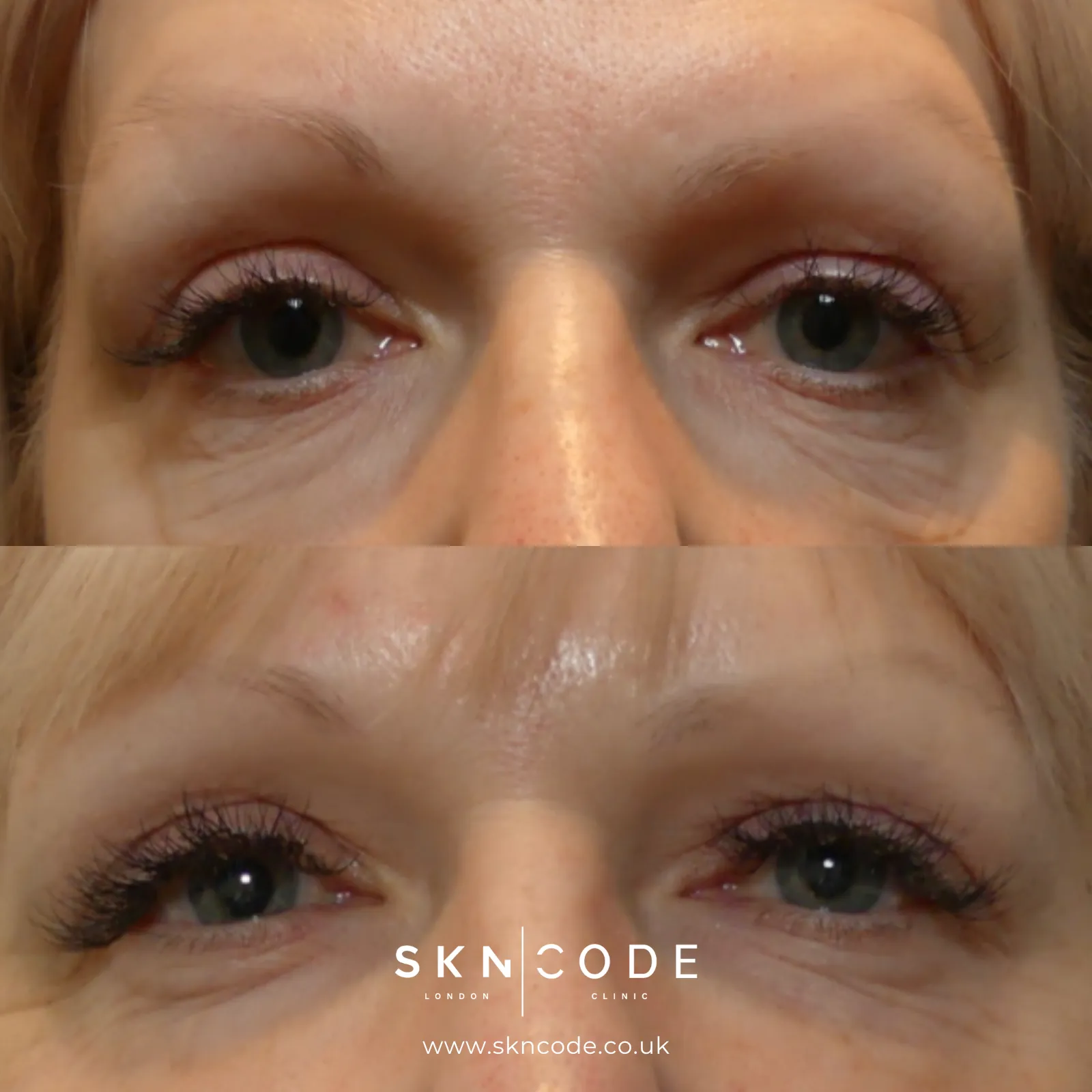 Before and after Morpheus8 at SKNCode London Clinic, photo 2