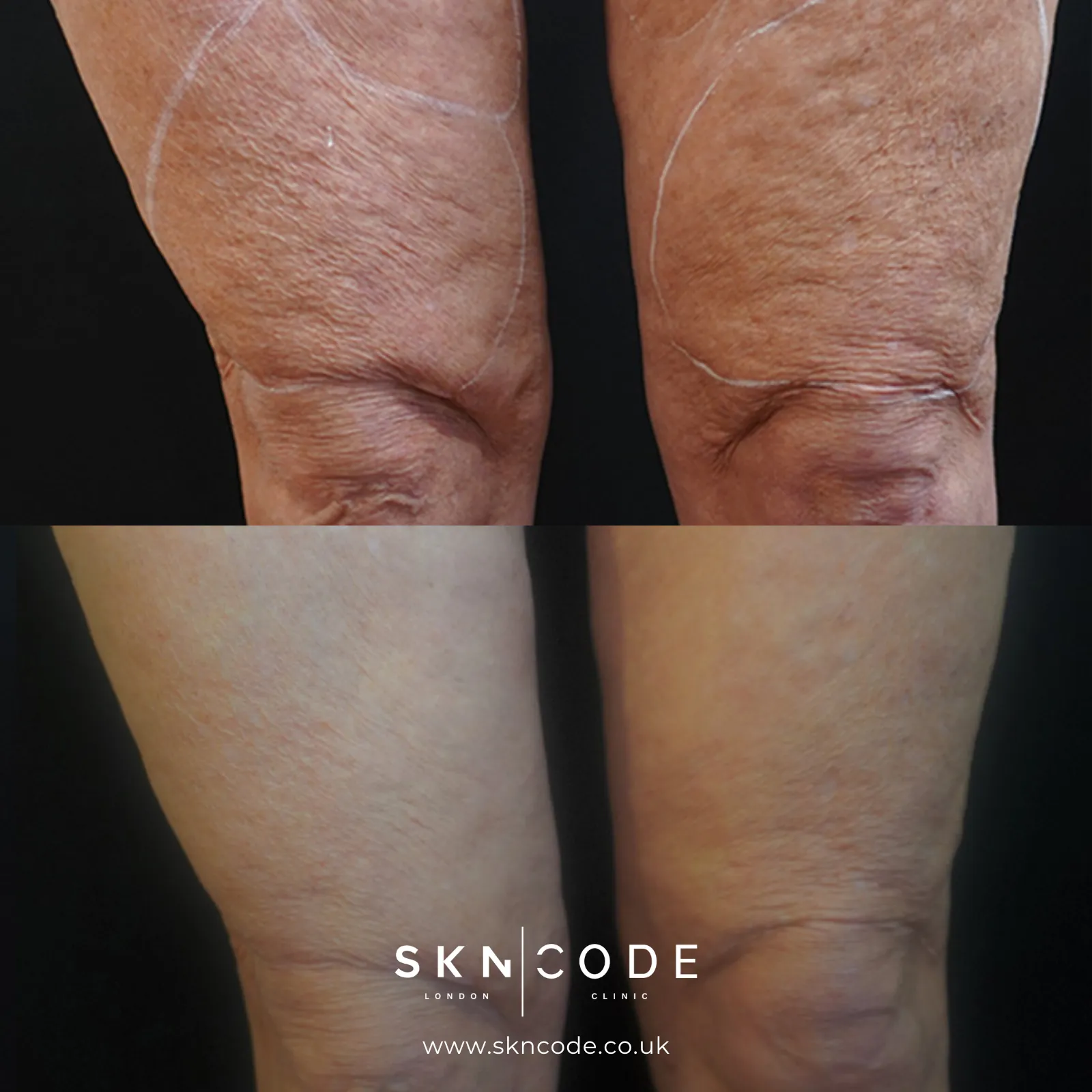 Before and after Morpheus8 at SKNCode London Clinic, photo 3