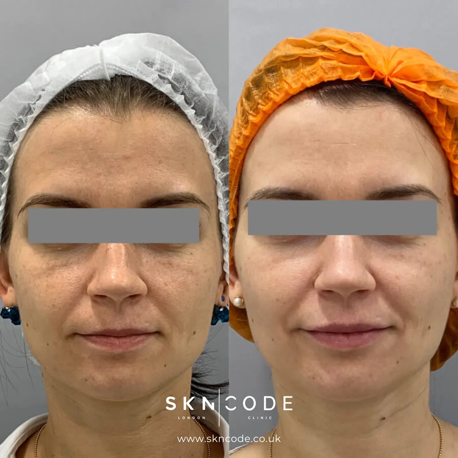 Before and after QMR at SKNCode London Clinic, photo 1