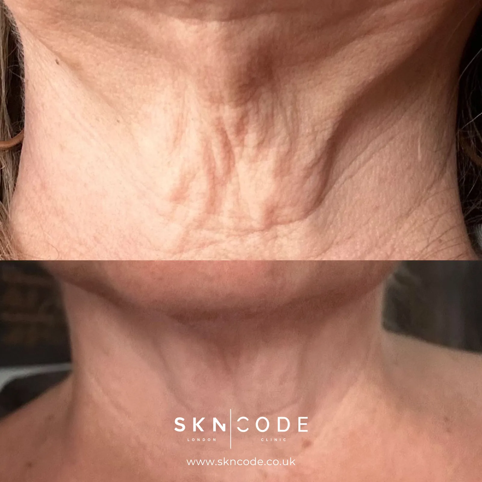 Before and after QMR at SKNCode London Clinic, photo 2