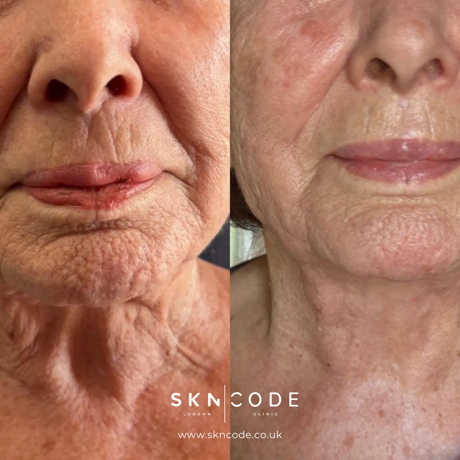 Before and after QMR at SKNCode London Clinic, photo 3