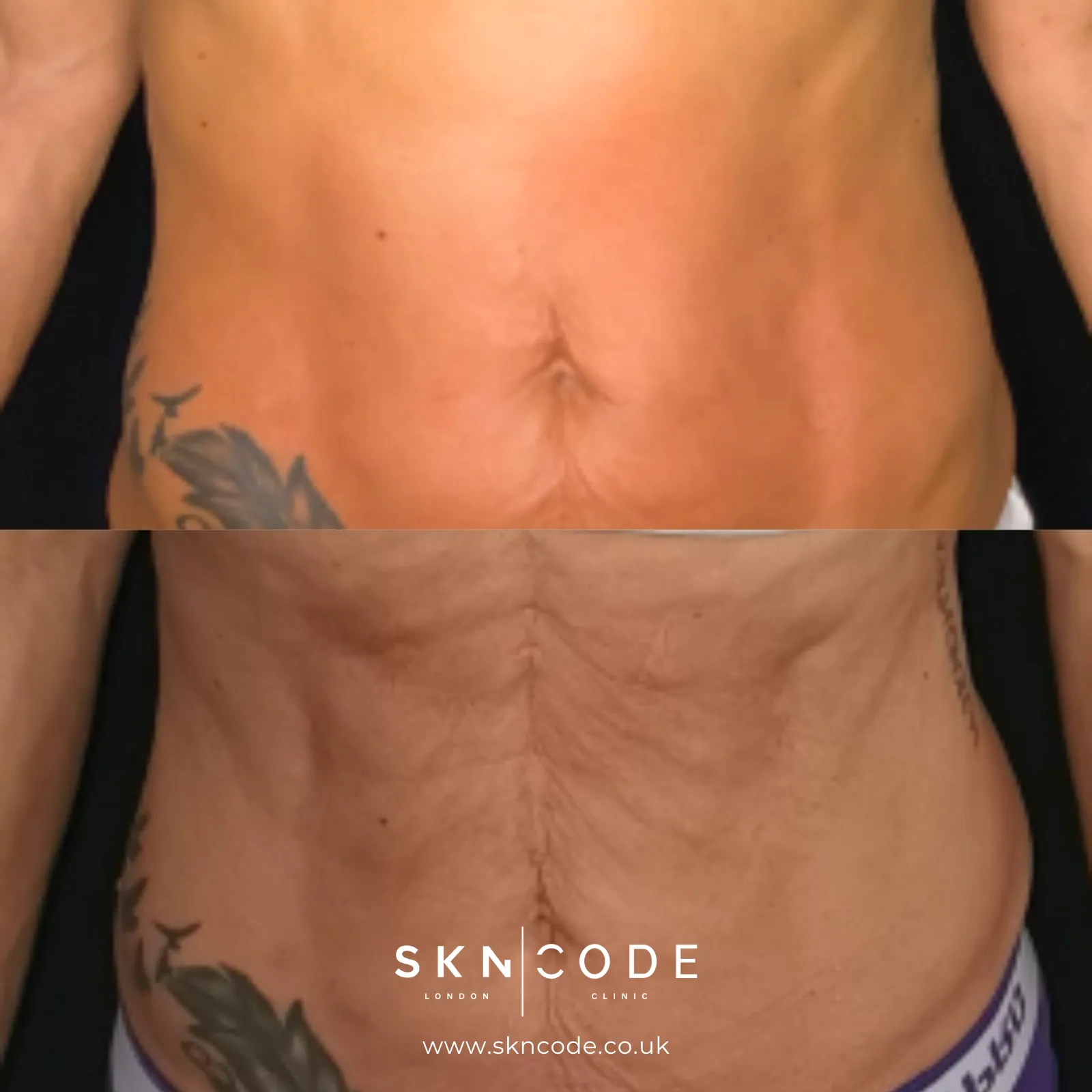 Before and after Tesla Former at SKNCode London Clinic, photo 1