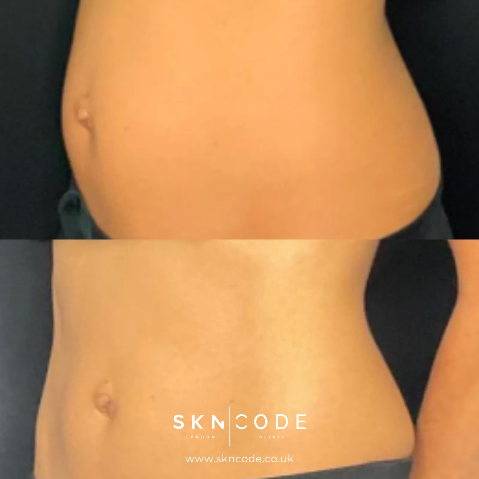 Before and after Tesla Former at SKNCode London Clinic, photo 2