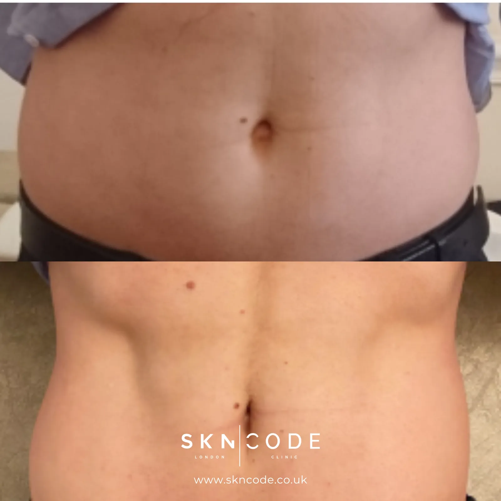 Before and after Tesla Former at SKNCode London Clinic, photo 3