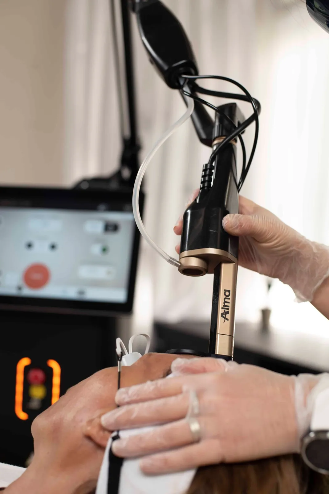Practitioner using the Alma Hybrid laser handpiece during a facial resurfacing treatment